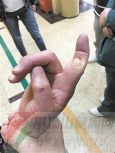 四川德阳市人民医院保安掰断发传单妇女手指