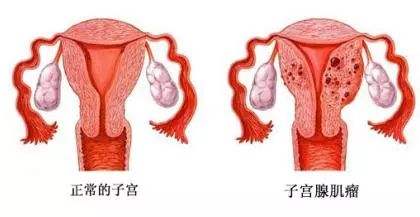 子宫肌瘤变性≠恶变