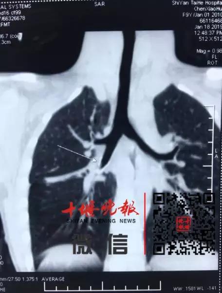 8岁女童体内竟传出吹哨子的声音！医生一查，惊呆了