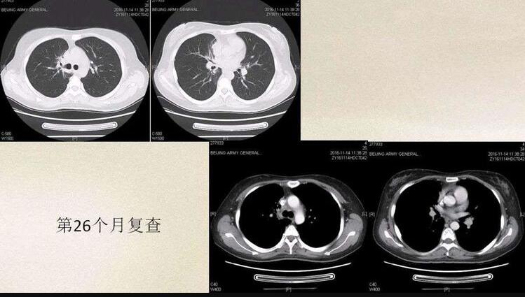 为什么大部分小细胞肺癌，不能动手术？