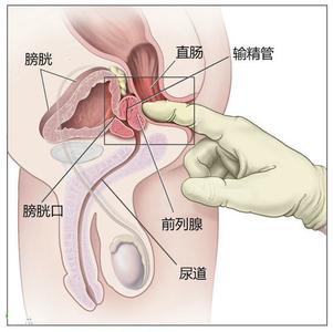 前列腺炎怎样治疗会有效果