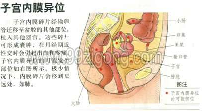 子宫内膜异位症