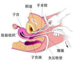 人流后子宫修复组合适宜人群
