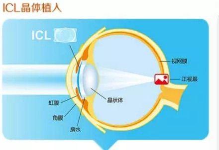 南阳市眼科医院人工晶体专家...