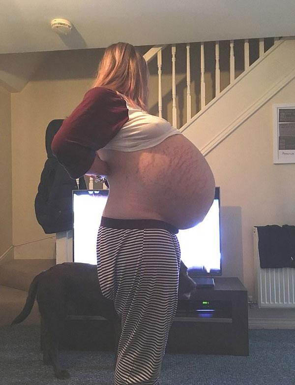 英妇女手术摘除26公斤重囊肿 曾错以为怀孕