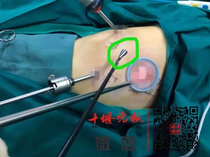 8岁女童体内竟传出吹哨子的声音！医生一查，惊呆了