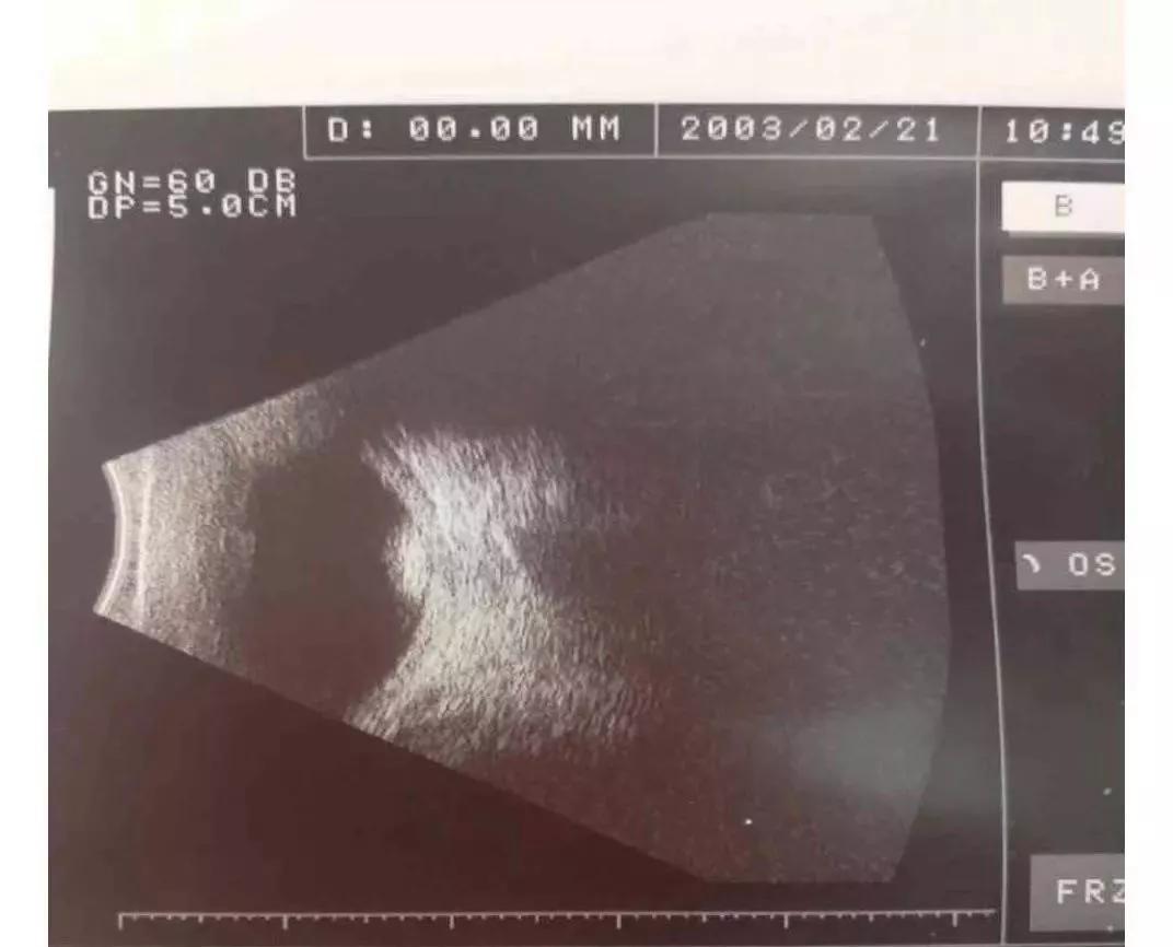 眼睛也会长癌？——视网膜母...