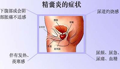 精囊炎的临床表现