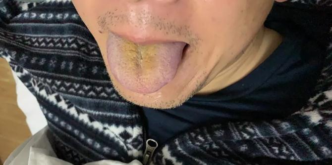 半副药退去新冠病毒热，3天走出鬼门关！广安门医院呼吸科主任的做法转给所有人