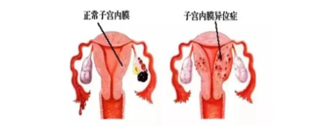 痛经可不只是痛那么简单，可能隐藏哪些妇科疾患