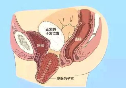 女性产后有这五种症状一定要到医院检查，有可能发生子宫下垂