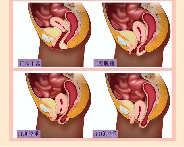 预防子宫脱垂(阴挺)  女性应该注意这些