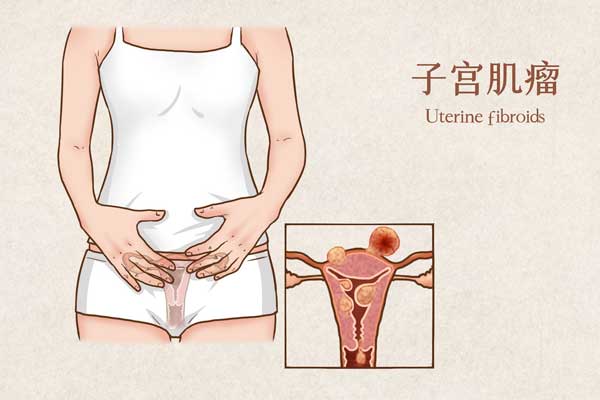 子宫肌瘤术后应该怎么保健